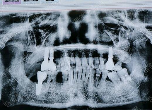 重庆美格尔齿科门诊牙齿种植案例