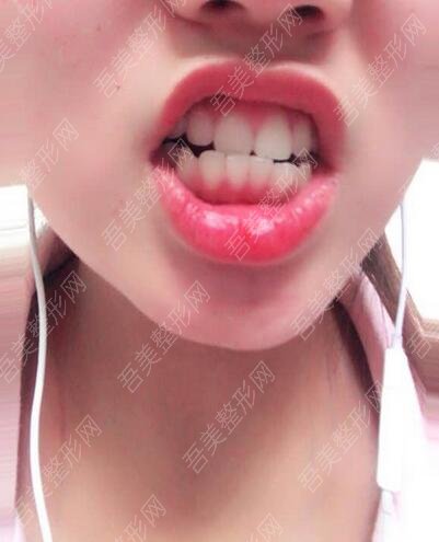 重庆小泊牙口腔医院牙齿矫正案例