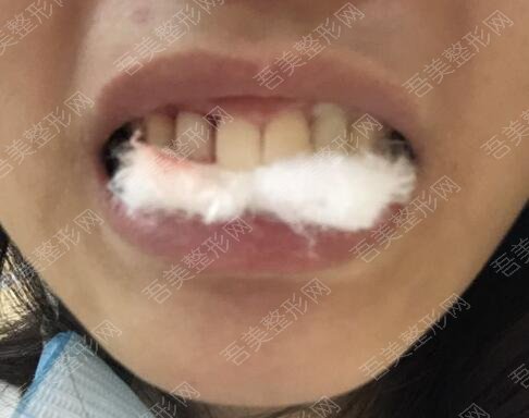 重庆小泊牙口腔医院牙齿种植案例