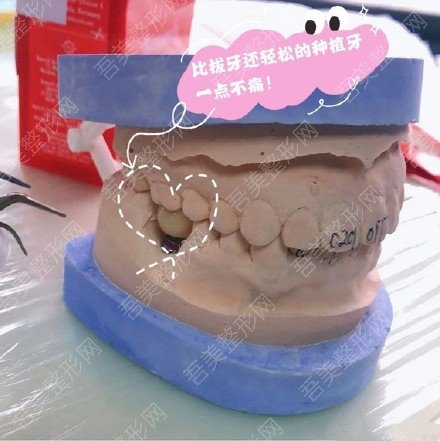 涪陵佳欣口腔医院牙齿种植案例