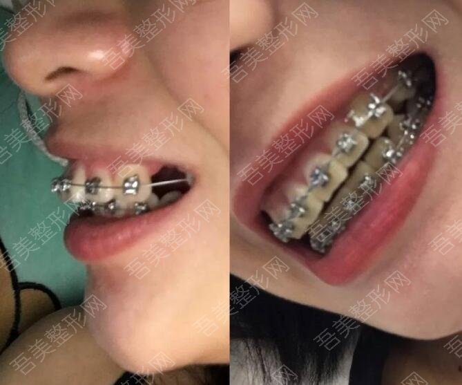 重庆爱牙口腔医院牙齿矫正案例