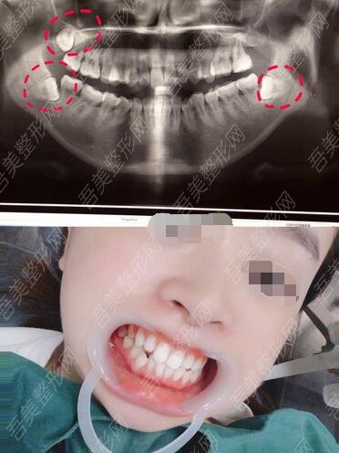 上海地区牙科医院牙齿矫正果图