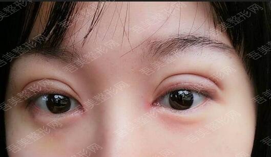 广州顺德中医院美容科埋线双眼皮手术案例