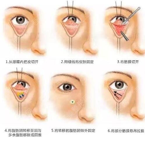 南方医科大学深圳医院整形美容科内切祛眼袋手术