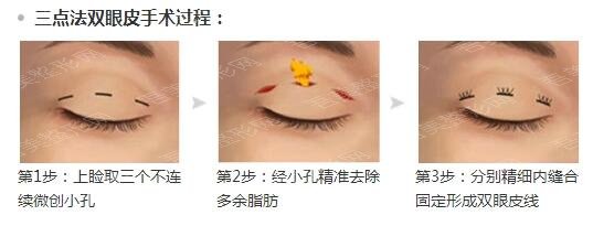 南方医科大学深圳医院整形美容科双眼皮修复手术