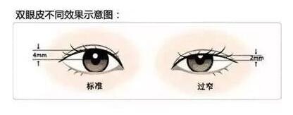 上海第九人民医院整形外科双眼皮修复手术