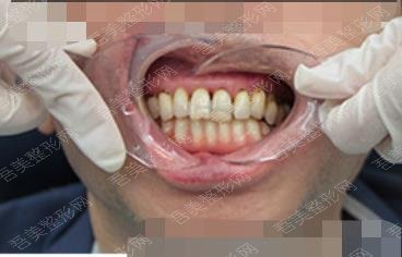 做牙齿种植手术之后