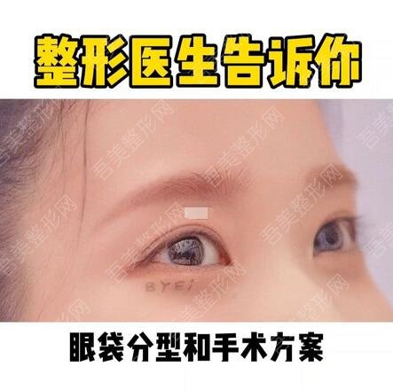 上海第六人民医院整形外科祛眼袋手术体验