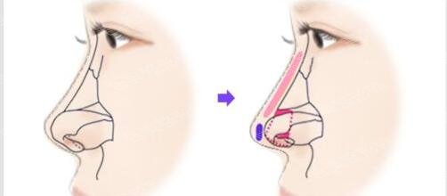 鼻部手术整形手术原理