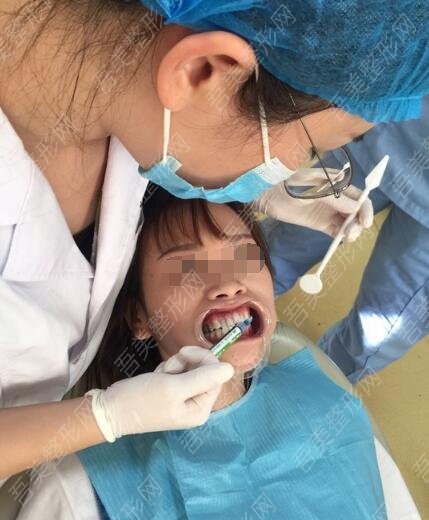 暨南大学附属第一医院口腔科牙齿矫正果图