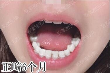 深圳贝齿美口腔门诊部项目案例（牙齿矫正）