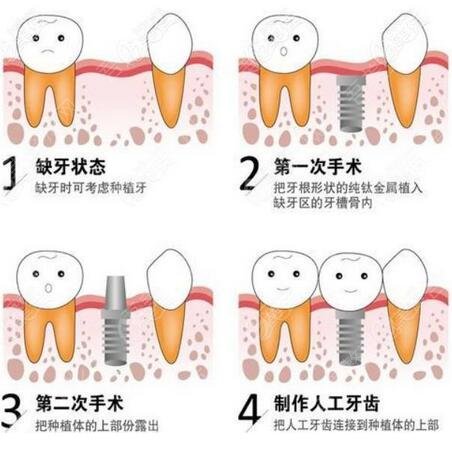 深圳贝齿美口腔门诊部牙齿种植手术