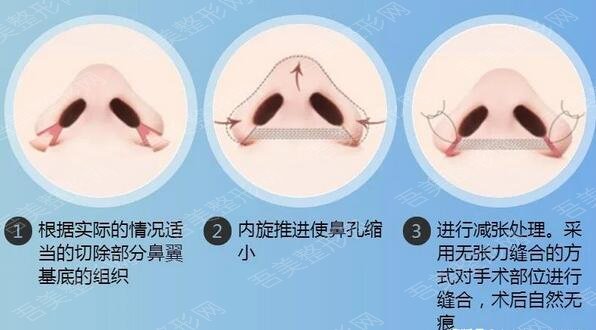 南京地区肋骨隆鼻整形案例效果图