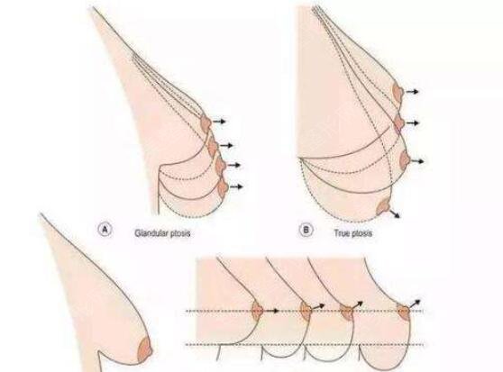 乳房下垂悬吊术