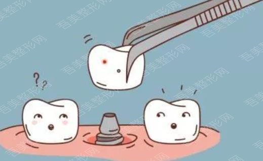 牙齿种植
