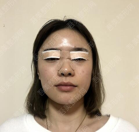 荆州中心医院整形外科做双眼皮案例