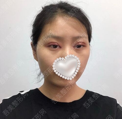 上海华美医疗美容医院双眼皮案例分享