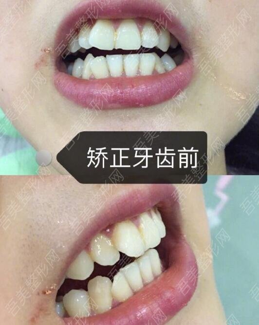 维乐口腔医院牙齿矫正案例分享