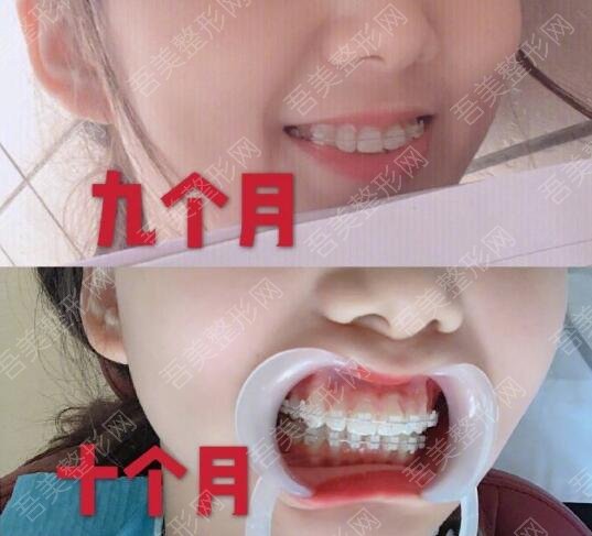 维乐口腔医院牙齿矫正案例分享