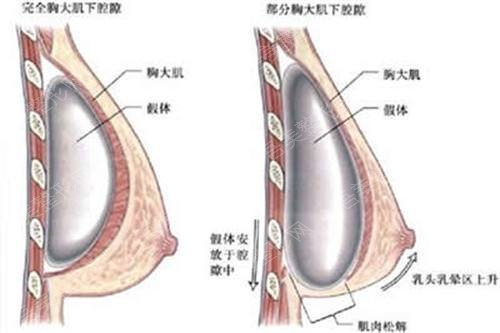 北京协和医院科普隆胸手术