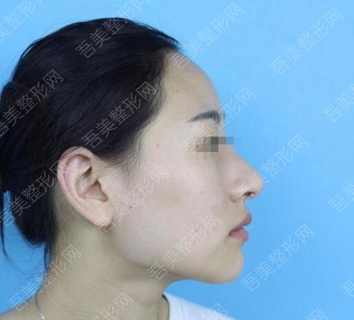 四、韩国korea整形下颌角整形案例