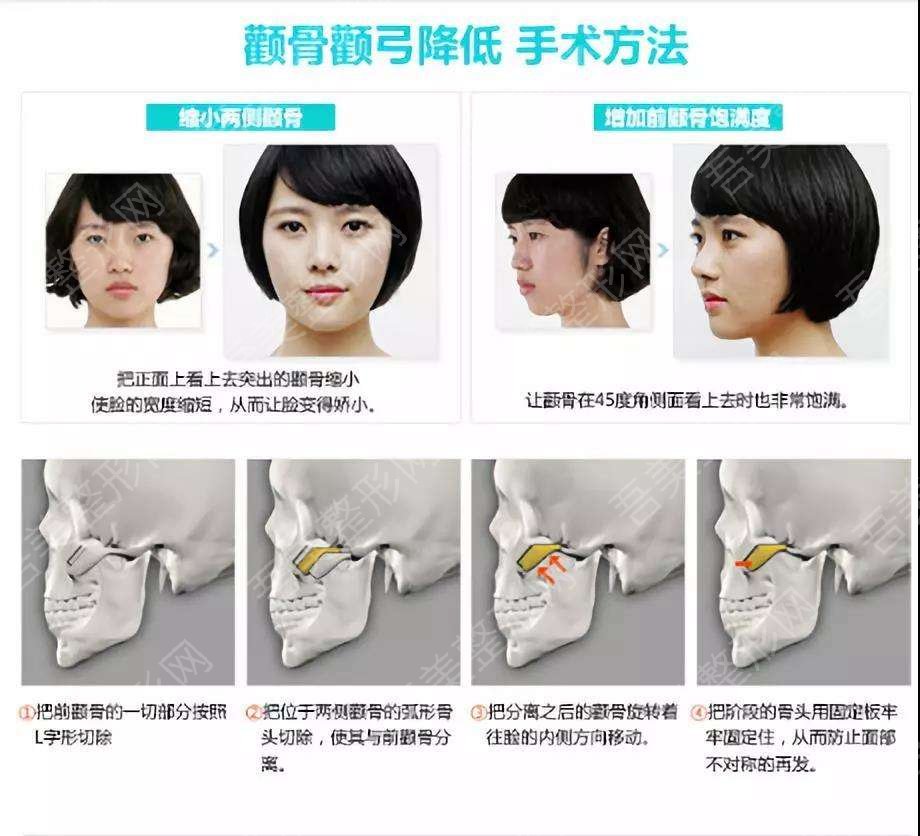 上海九院余东医生科普颧骨整形的两种方法