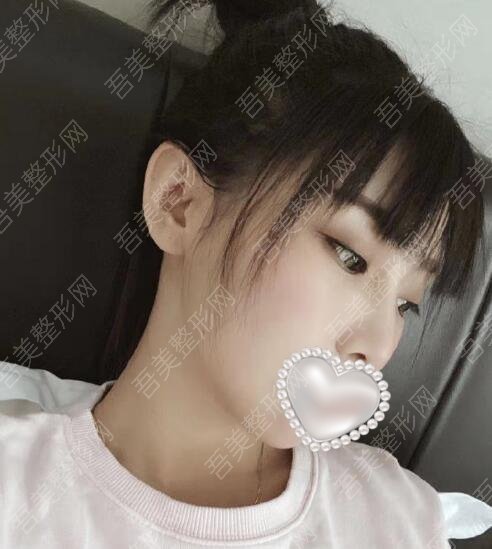 上海九院改脸型专家韦敏医生下颌角案例
