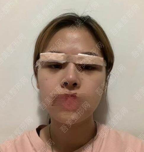 北京刘风卓做双眼皮修复案例