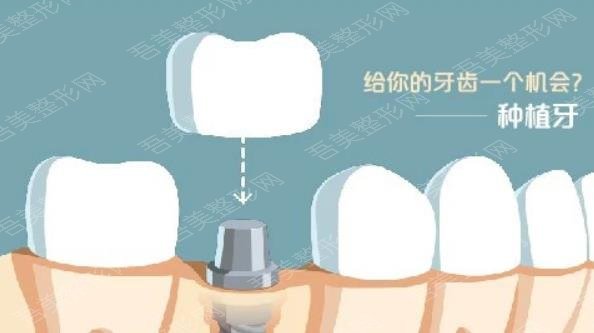 牙齿种植hg011.jpg