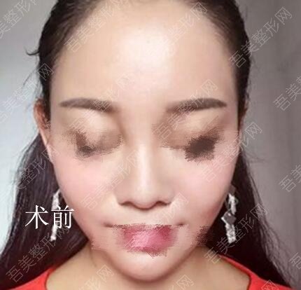 深圳四季医疗美容做鼻子案例分享